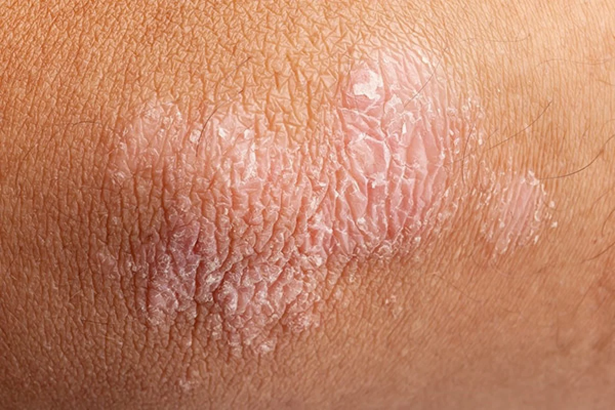 CinfaSalud-psoriasis-600-1200x800 (1)