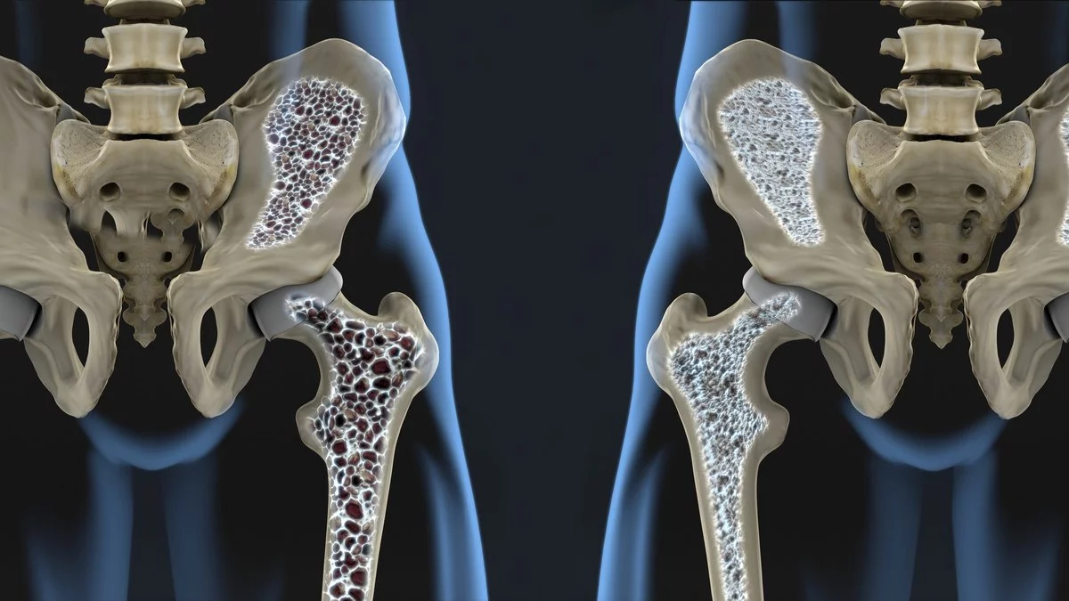 osteoporosis-enfermedad.jpg