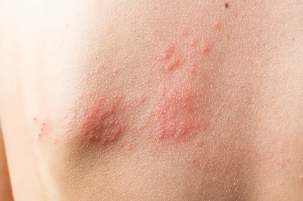 dermatitis-atopica-scaled